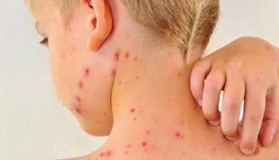 أودت بحياة طفلين.. تكساس تطوي صفحة تفشي الحصبة بعد 6 أسابيع